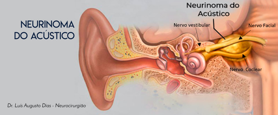 neurinoma-do-acustico---dr-luis-augusto-dias-neurocirurgião-em-brasilia